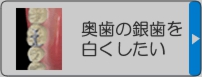 奥歯の銀歯を白くしたい
